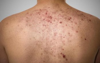 How To Get Rid Of Acne On Your Back - 6 Curing Tips