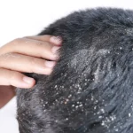 How to Get Rid of Dry Dandruff for a Healthy, Dandruff-Free Scalp