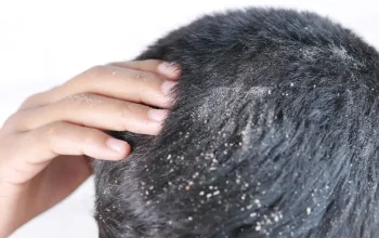 How to Get Rid of Dry Dandruff for a Healthy, Dandruff-Free Scalp