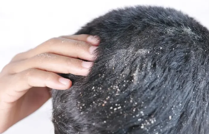 How to Get Rid of Dry Dandruff for a Healthy, Dandruff-Free Scalp