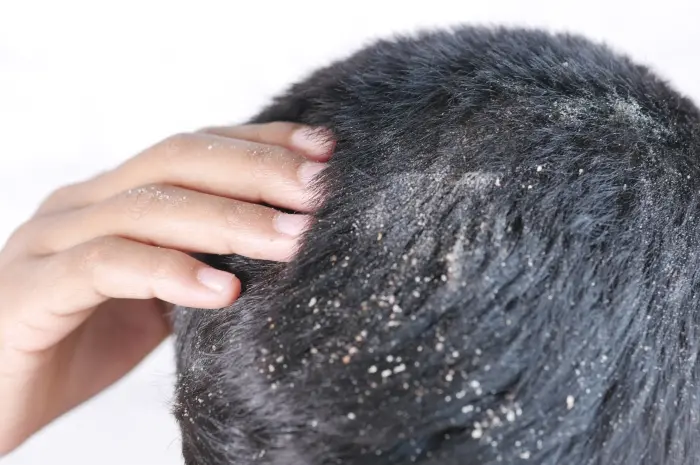 How to Get Rid of Dry Dandruff for a Healthy, Dandruff-Free Scalp